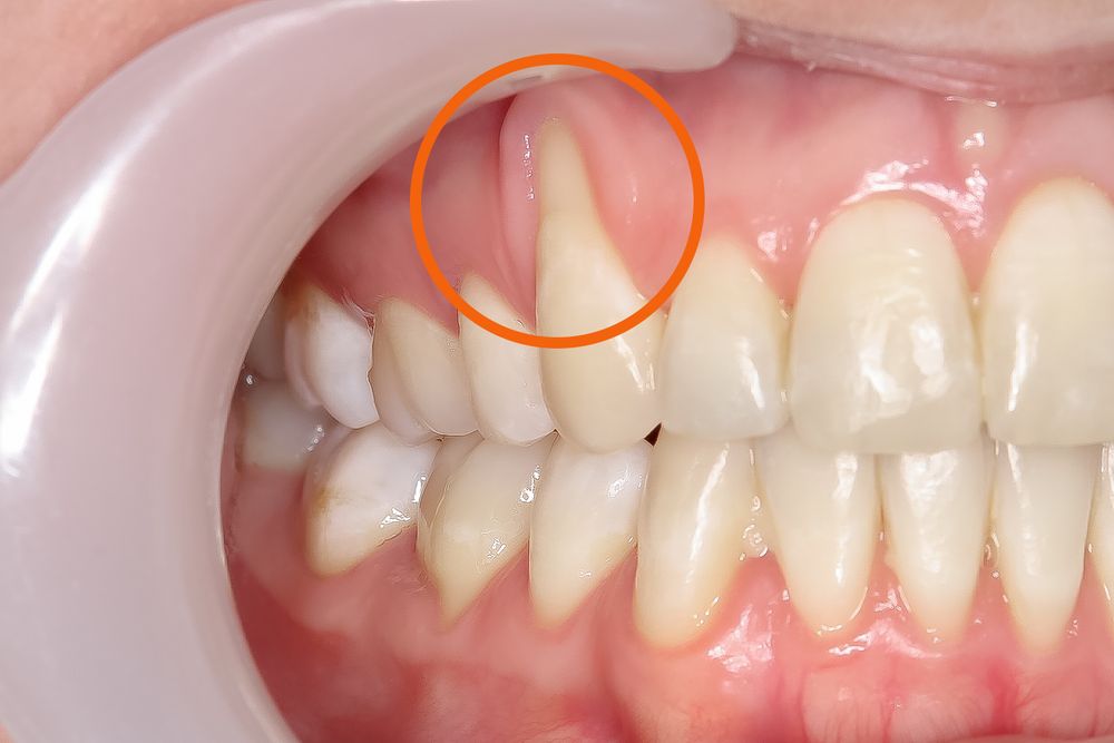 gum recession - 3Dental